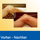 Vorher Nachher Erfolg Lymphdrainage Abnahme